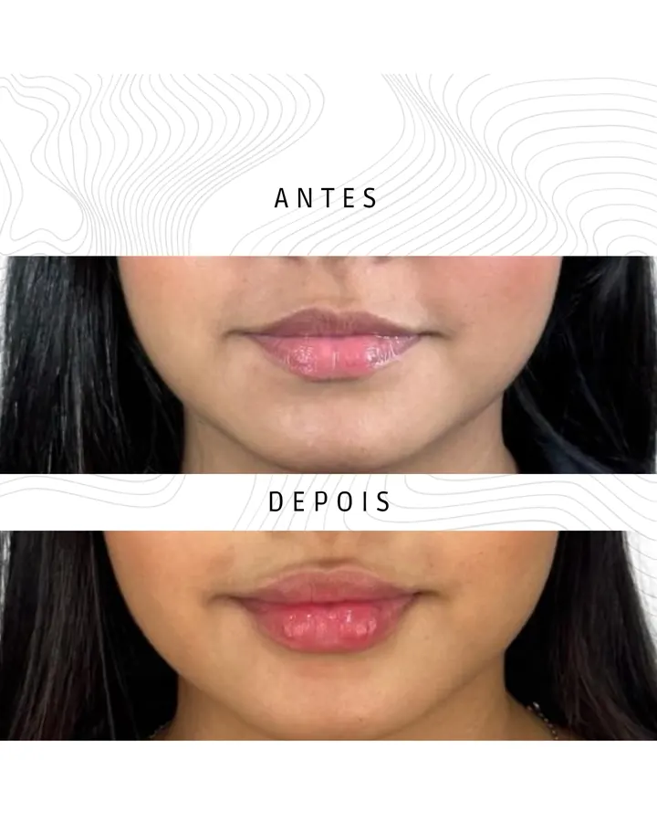Preenchimento Labial — paciente 1